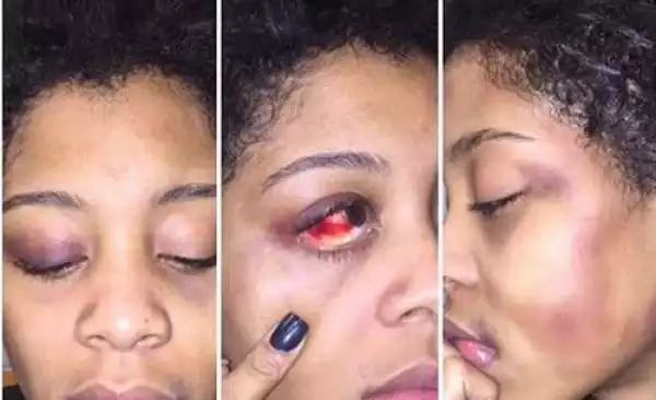 Broken Eye Socket, Knocked Teeth & More: Lady Shares Her Heartbreaking Domestic Violence Story